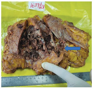 Gross showing cut surface of the lesion showing a well-encapsulated, multilobulated, cystic friable mass filled with necrotic and hemorrhagic areas (blue arrow).